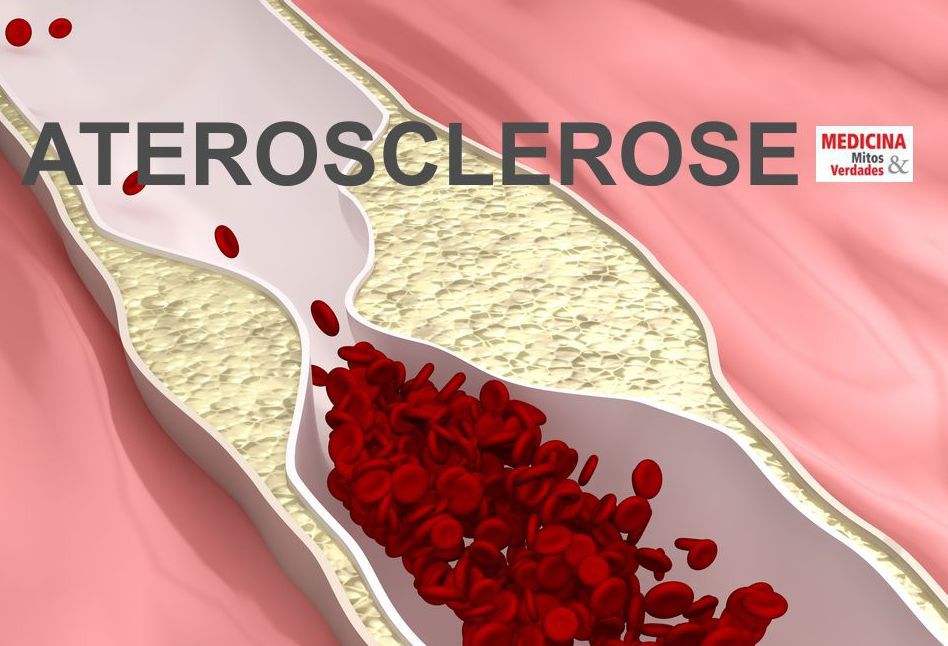 Mais rigor contra colesterol