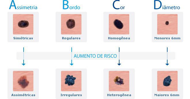 Cuidado com as pintas do seu corpo