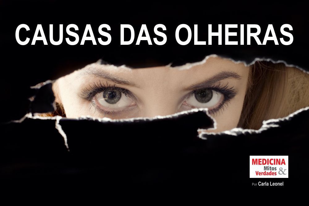 As causas das olheiras