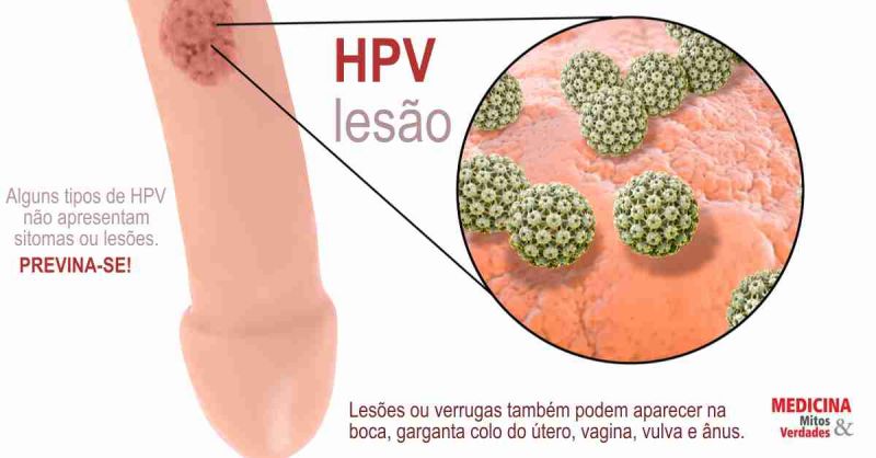 HPV la bărbat. Simptome și tratament