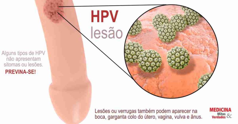 verrue hpv homme