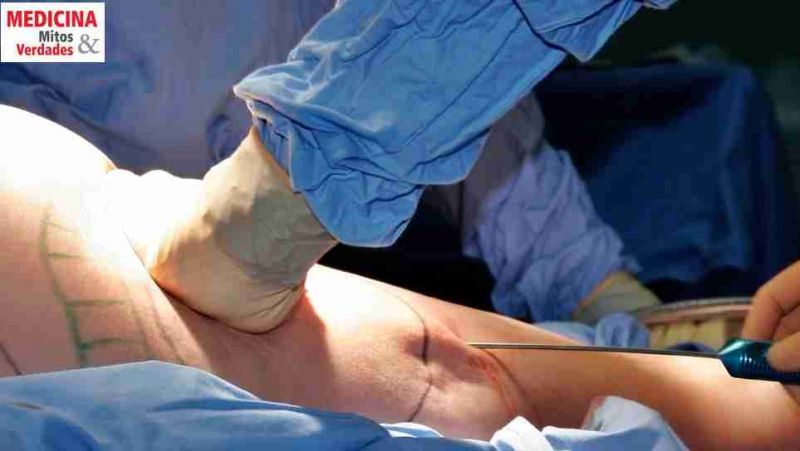 Excesso de gordura - lipoaspiração ou abdominoplastia?