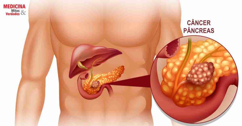 Câncer no pâncreas: causas, sintomas, diagnóstico, tratamento e prevenção