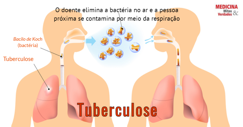 Tosse e tuberculose: falta de tratamento leva à morte | Medicina - Mitos e  Verdades