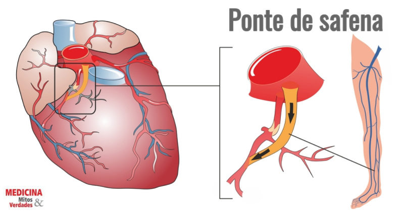 Ponte de safena e mamária: diferença, indicações e riscos da cirurgia