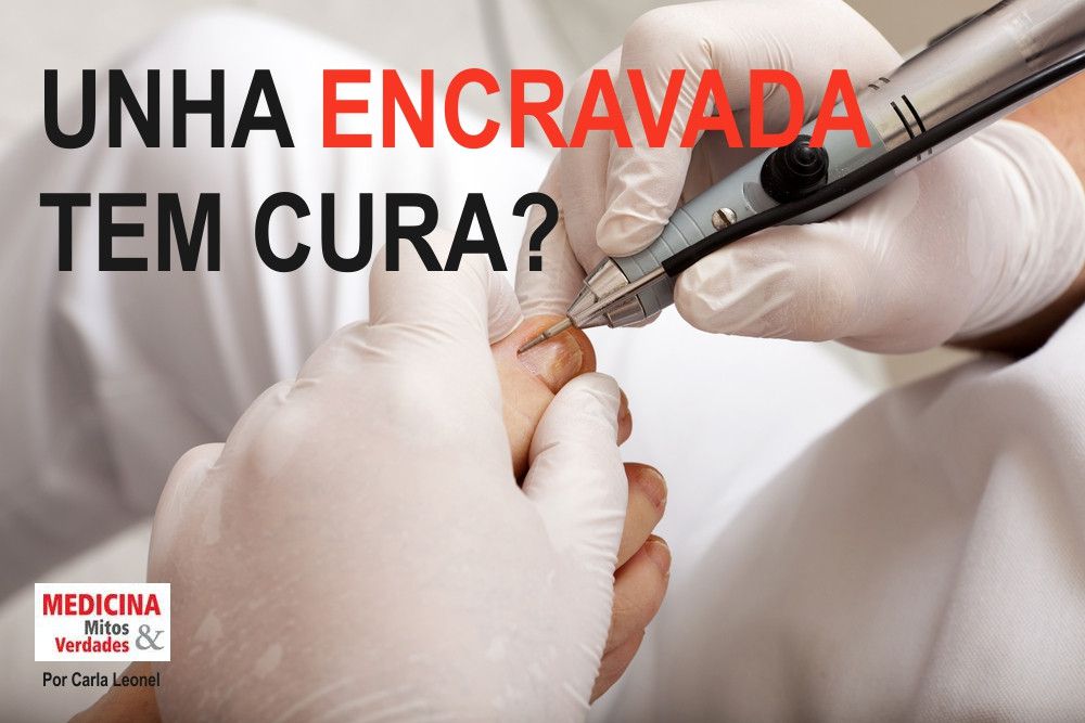 Unha encravada tem cura?