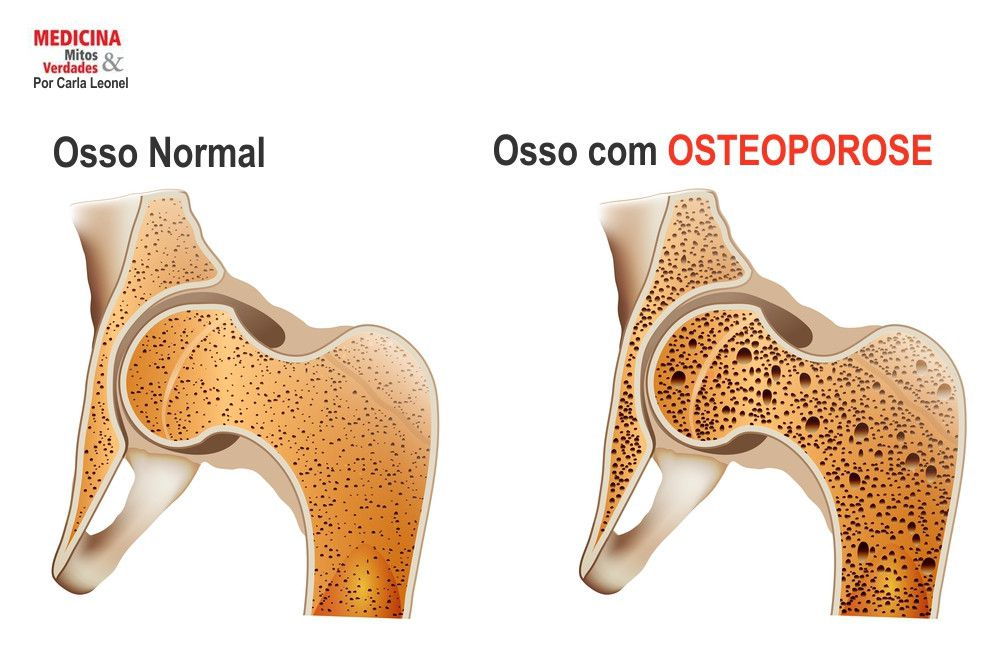 Como tratar a osteoporose?