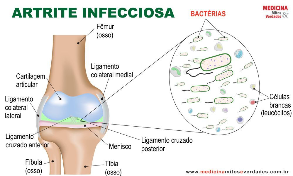 artrite septica tratamento)