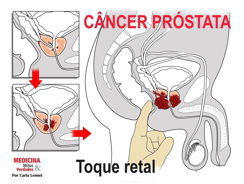 cancer prostata sintomas avancado)