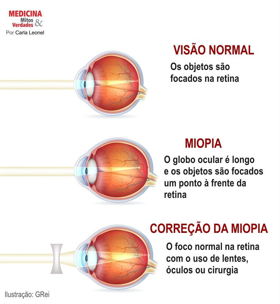 Miopia - clasificarea miopiei - optica ochiului miop