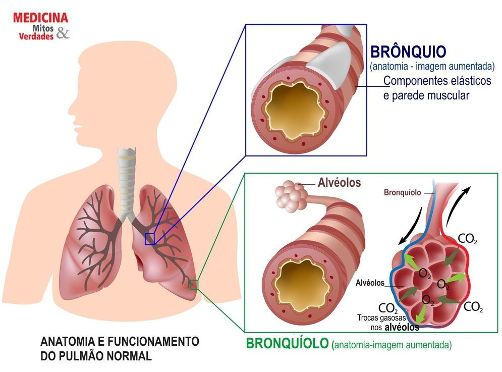 Bronquiectasias: causas, sintomas e tratamento | Medicina - Mitos e Verdades