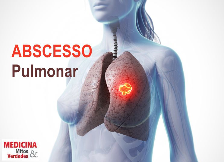 Causas do abscesso pulmonar