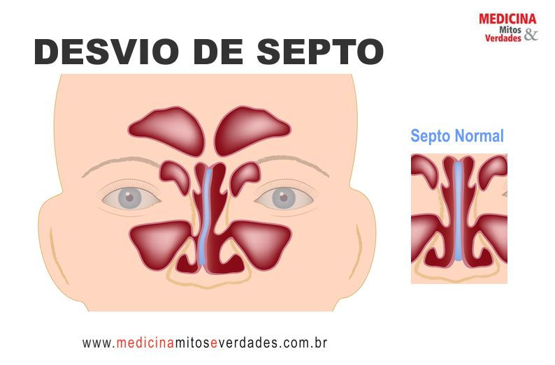 Causas e sintomas do desvio de septo