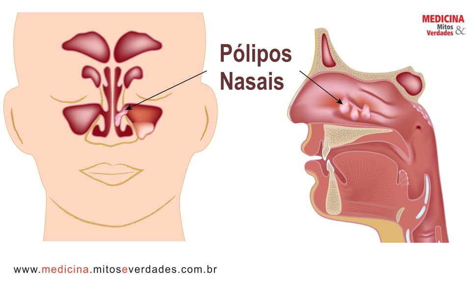 Pólipos no nariz altera o olfato