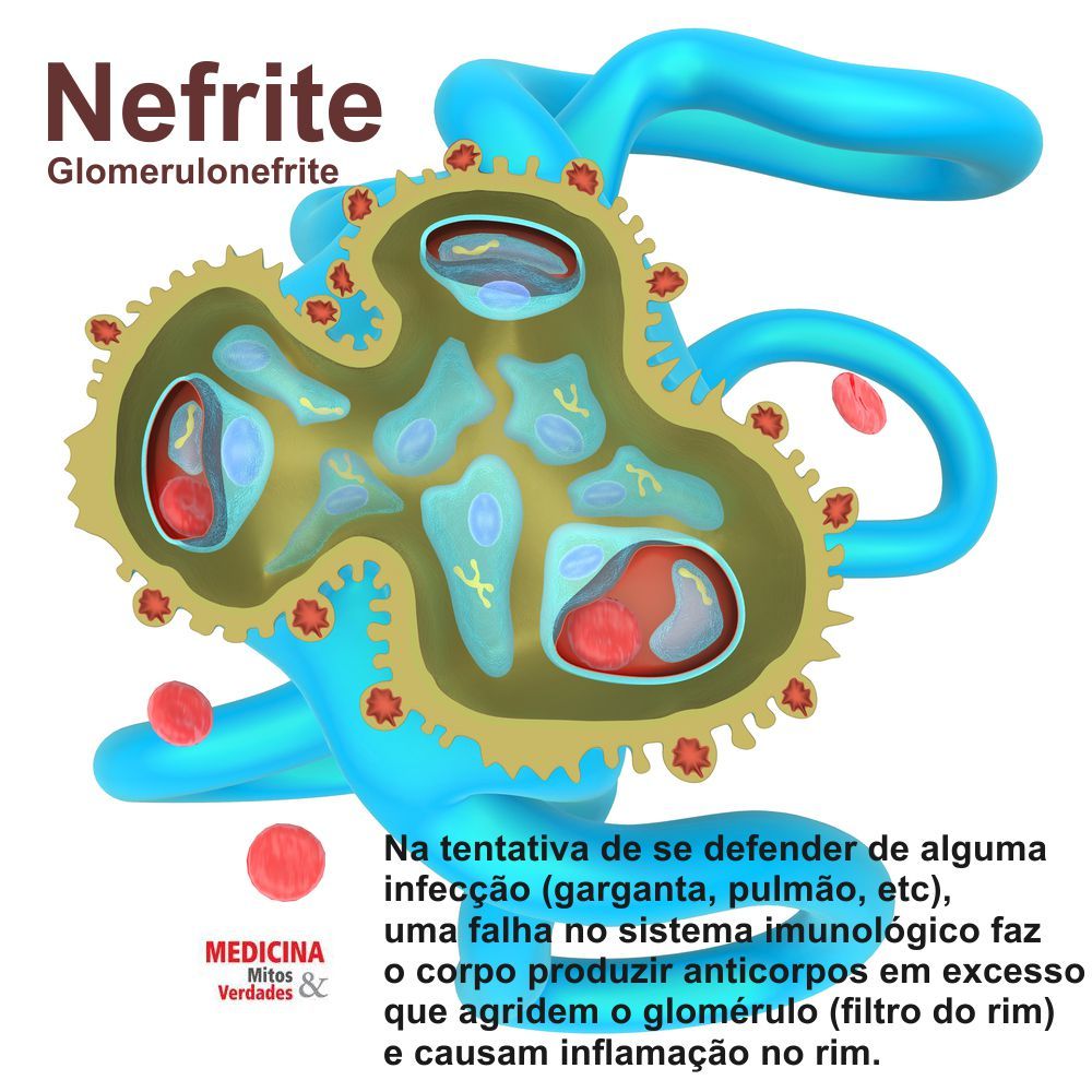 Causas e sintomas da nefrite