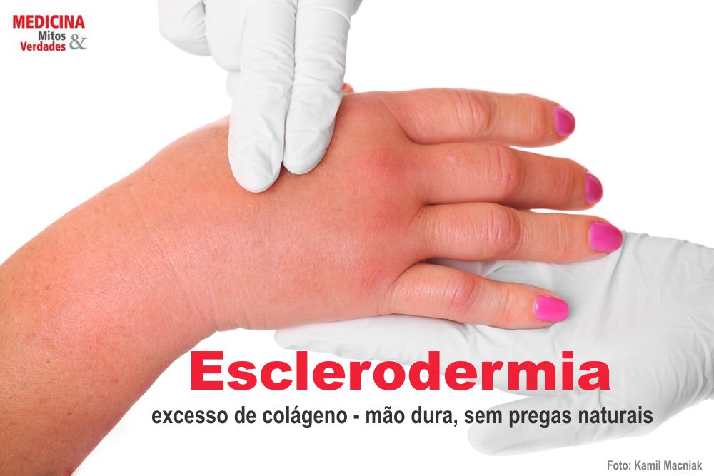 Pele endurecida e esclerodermia