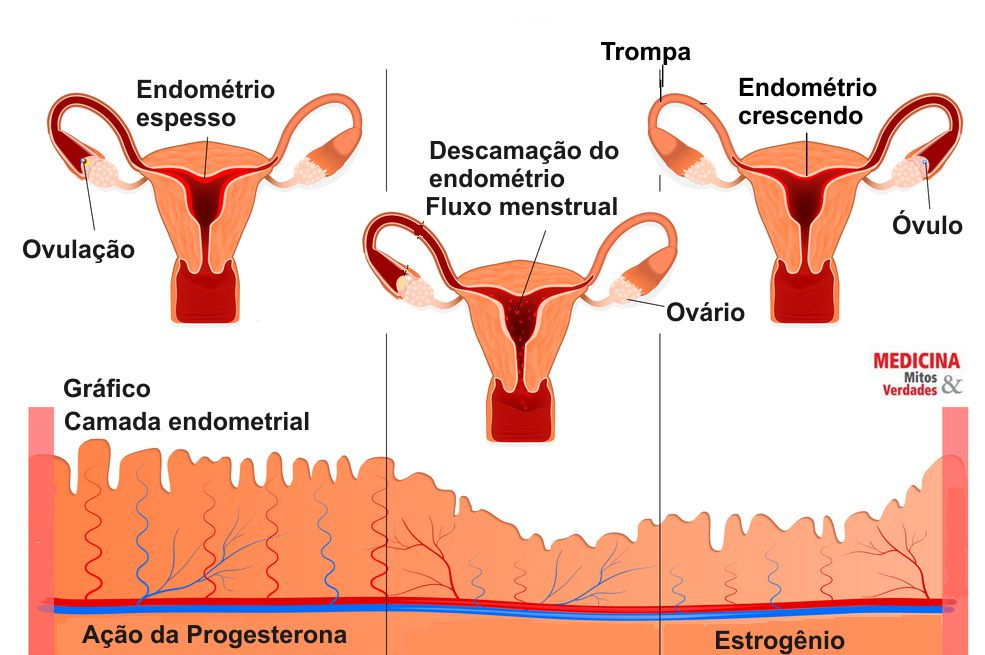 Menstruação com coágulos na endometriose - BedMed