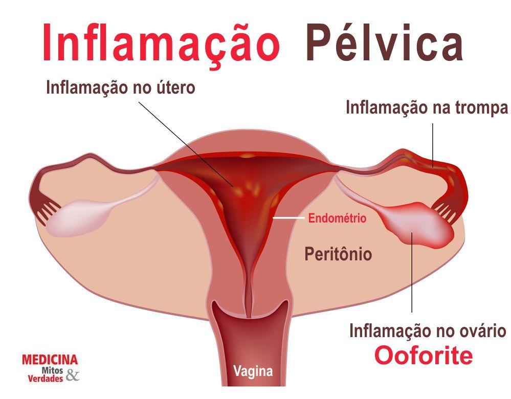Ooforite ou ovarite? Entenda mais sobre essa inflamação!