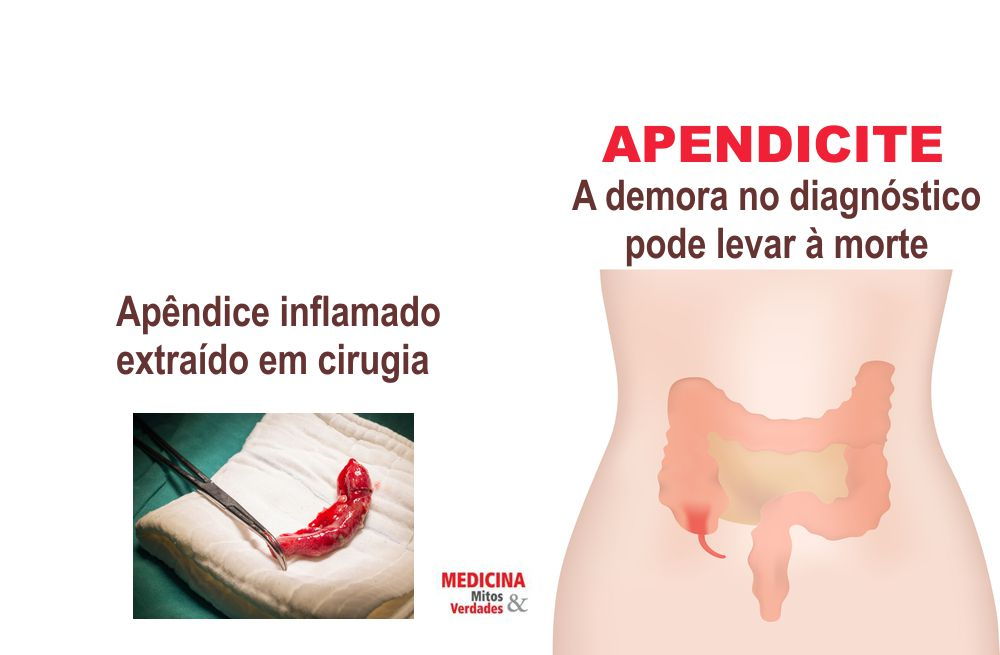 A importância do diagnóstico da apendicite aguda nas primeiras 24 horas Medicina Mitos e